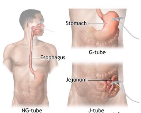 Types of Enteral Feeding Tubes Types of Enteral Feeding Tubes